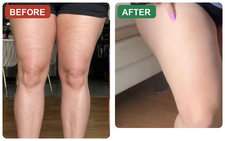 Before and after - visible cellulite dimpling reduced after 15 days
